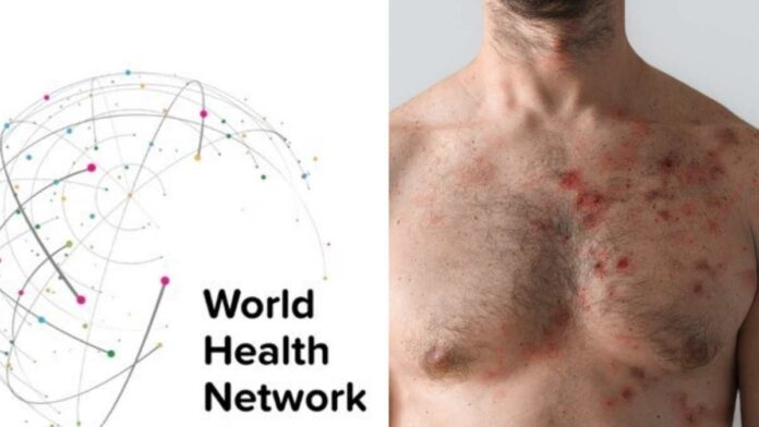 WHN declares Monkeypox global health emergency